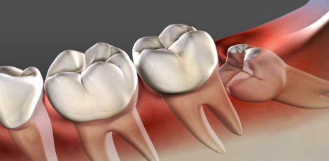 Various foods that we should eat for faster recovery after tooth extraction!!