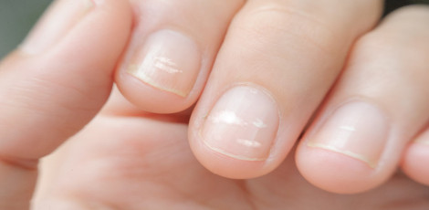 If you have white spots on your nails, then you might have these health issues!!