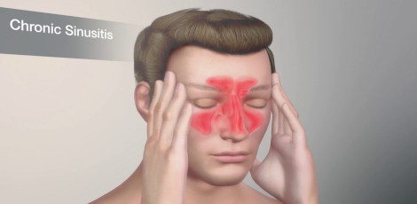 Worsening of sinus problems during the winter season can be due to these reasons!!