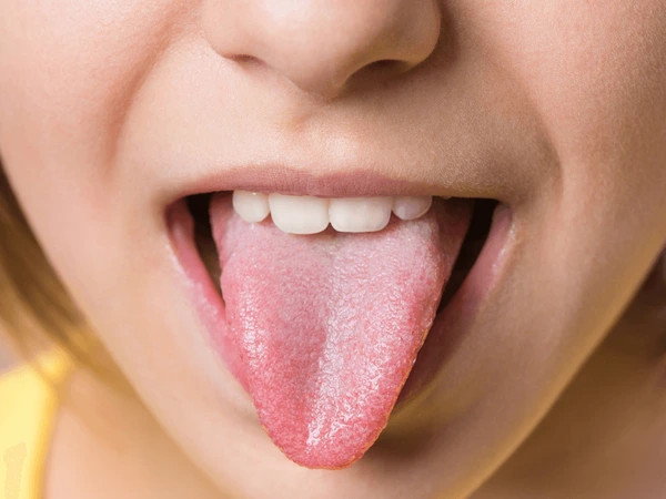 Different types of tongue colour would reveal about these health issues, take care!!