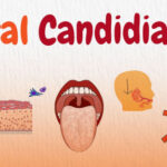 Important reasons why oral candidiasis or oral thrush occurs more in the seniors or elderly persons!!