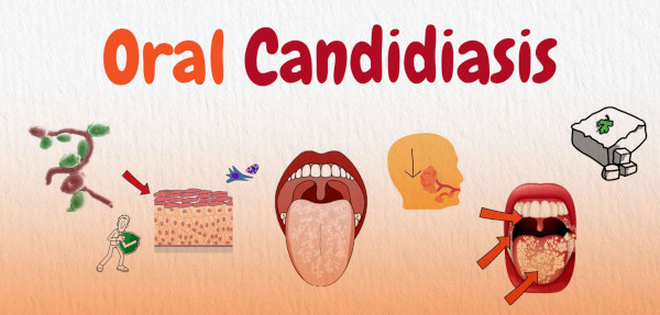 Important reasons why oral candidiasis or oral thrush occurs more in the seniors or elderly persons!!