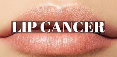 What is lip cancer? - Various reasons for lip cancer and treatments etc!!