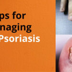 Nail psoriasis condition, its signs and treatments etc - Important things to know!!