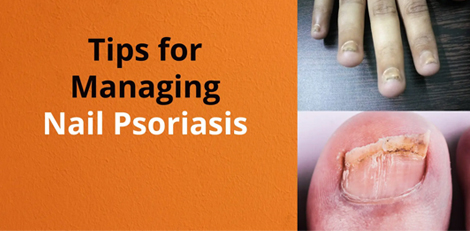 Nail psoriasis condition, its signs and treatments etc - Important things to know!!