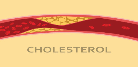 Relationship between yellow coloured growths on the eyelids and heart attacks etc - A simple method to treat high cholesterol levels at home!!