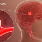 Brain Aneurysm - symptoms, risk factors and treatments etc - Important things to know!!