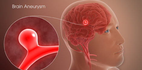 Brain Aneurysm - symptoms, risk factors and treatments etc - Important things to know!!