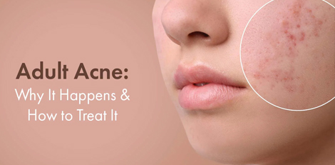 Adult Acne - Causes, treatments etc - Various important things to know!!